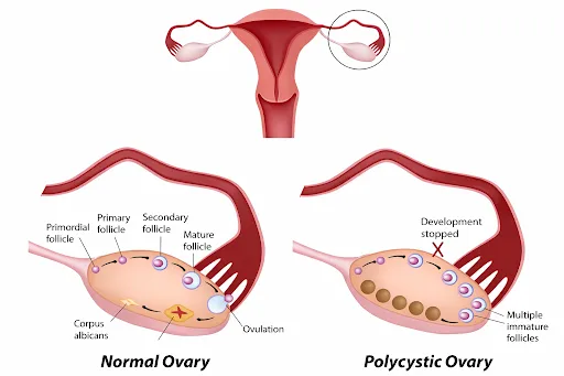 Is PCOS Genetic? How Dad’s Genetics Can Influence