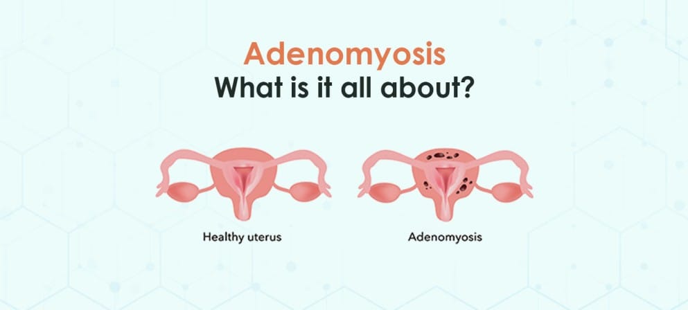 Adenomyosis. What is it all about?