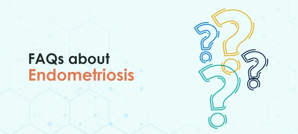 FAQs about Endometriosis