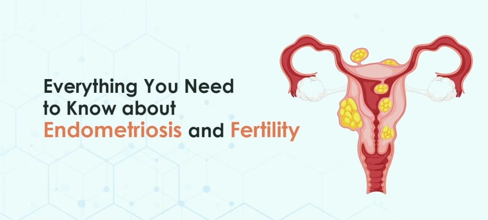 Know about Endometriosis and Fertility