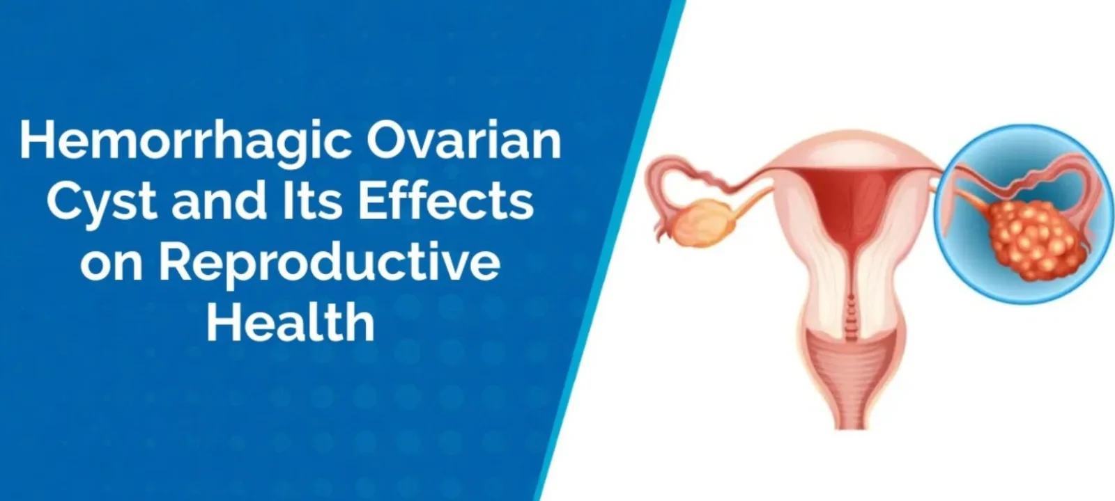 Hemorrhagic Ovarian Cyst and Its Effects on Reproductive Health