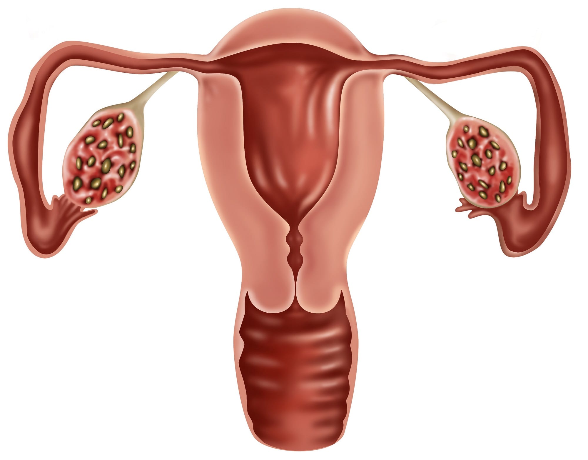 Polycystic Ovarian Syndrome