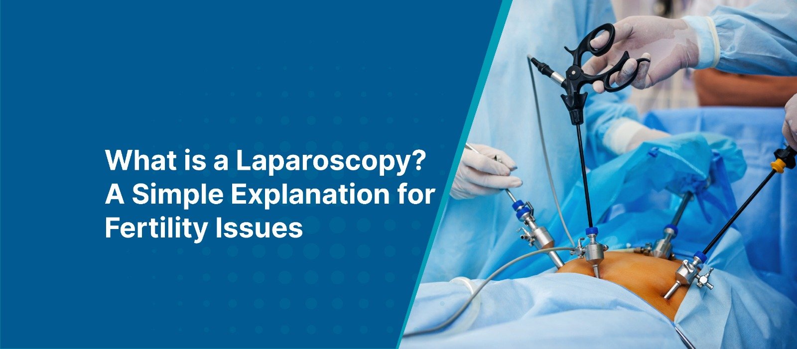 What is a Laparoscopy? A Simple Explanation for Fertility Issues