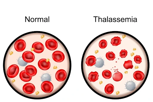 thalassaemia carrier screening from fertility specialist in Kolkata